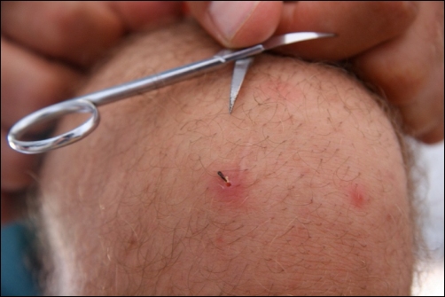 Sach had to conduct surgery to get a particularly nasty thorn tip out of his knee - Photo by James Conolly