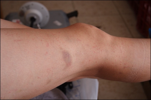Aftermath of Kate's Kermes Oak exposure - Photo by James Conolly