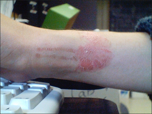 Burn update - May 1st